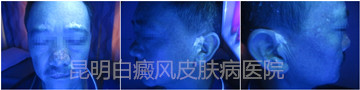 面部白斑五年余,在我成功治疗