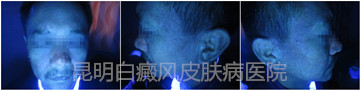 面部白斑五年余,在我成功治疗