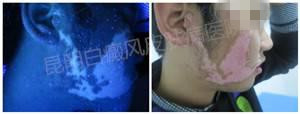 面部大面积白斑三年,在我院成功康复