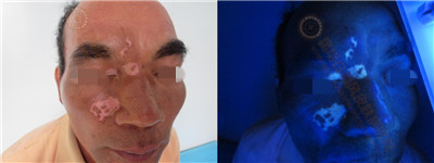 面部白斑三余年