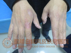 38岁男子手部白斑1年