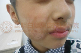 11岁男孩嘴角患白癜风