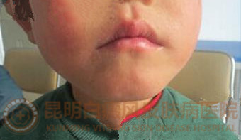 6岁男童右下颌白斑一年