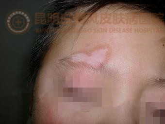 8岁男孩右侧眉上侧白斑1年