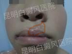 10岁男童左唇上方白斑