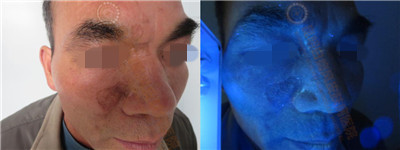 面部白斑三余年