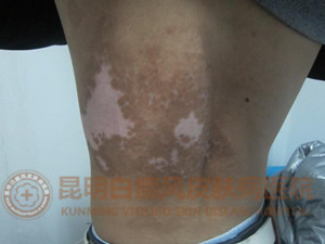 17岁男生背部大面积白斑