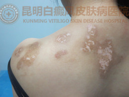 治疗三个疗程后