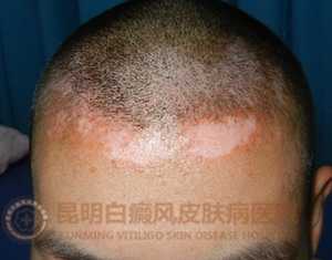 19岁男生额头白斑3年
