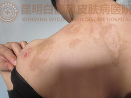 通过巩固治疗后