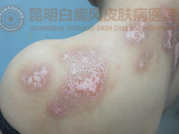 治疗两个疗程后