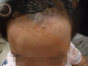 9岁女童额头发际中央部位白斑1个月