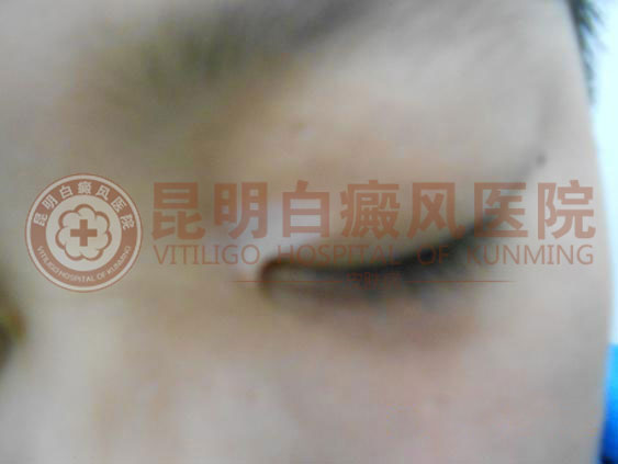 花季少年患白癜风一年