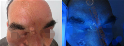 面部白斑三余年