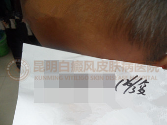 4岁男童先天白癜风