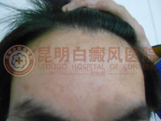 17岁男生前额发际处白斑