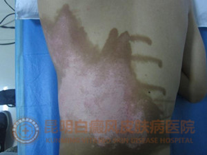 17岁男生背部大面积白斑