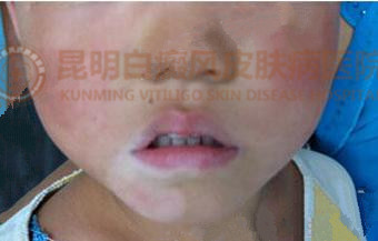 6岁男童右下颌白斑一年