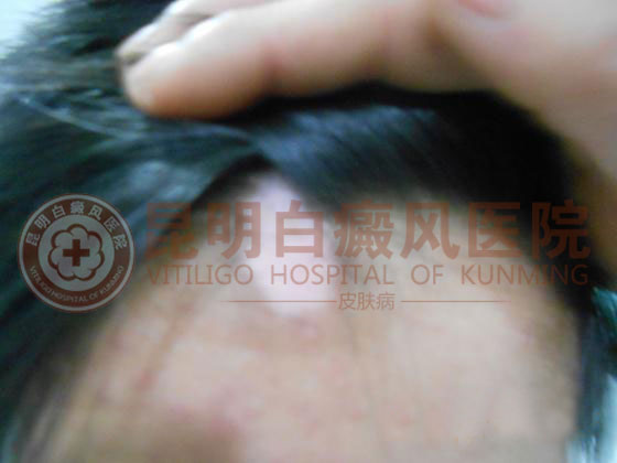 17岁男生前额发际处白斑
