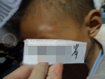 4岁男童先天白癜风