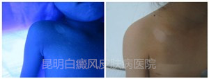 【初诊时,白斑明显,wood照射下,皮损处显乳白色】