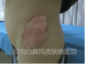 【治疗一个疗程后】