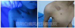 【治疗1个多月后,白斑处大量生成黑色素,wood灯下皮损范围缩小,疗效显著】