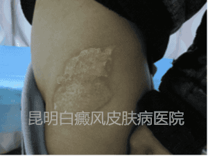 【三个疗程的治疗后白斑消失】