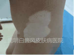 【初诊时患者右侧髂部白斑症状】