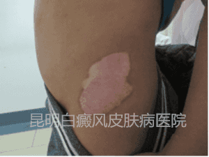 【治疗两个疗程后】