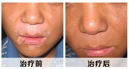 白癜风治疗时会有什么症状表现