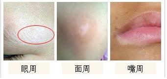 患上白癜风皮肤表面的症状表现是什么