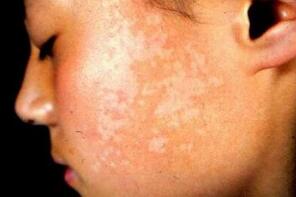 白癜风确定是稳定期该如何处理