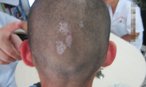 哪些是家族遗传性白斑病的症状表现