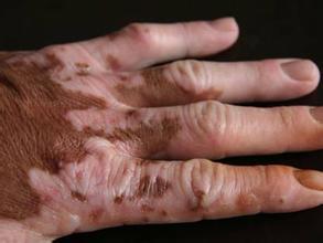 晚期白癜风会造成哪些伤害