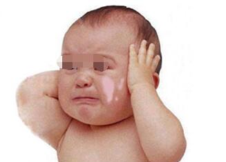 儿童患上白癜风该如何处理