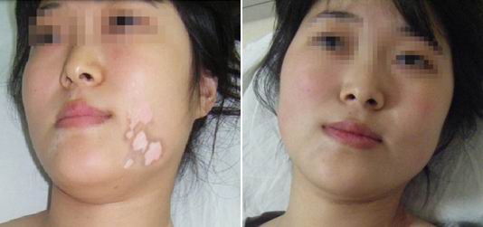 女性白癜风患者怎么调理