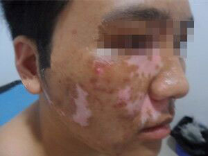 男性白癜风患者该如何对待病情