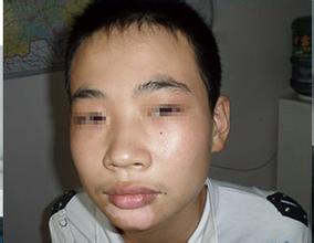 为什么有的男性白癜风一直治不好