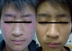 面部白癜风的治疗方法是什么