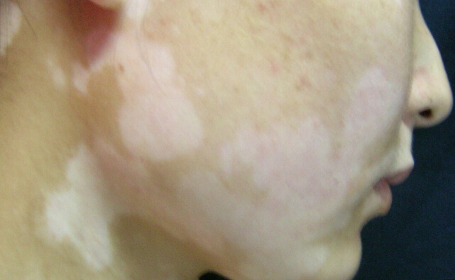 脸上出现白癜风后该怎么对待