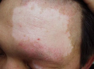 面部白癜风病人能喝水吗