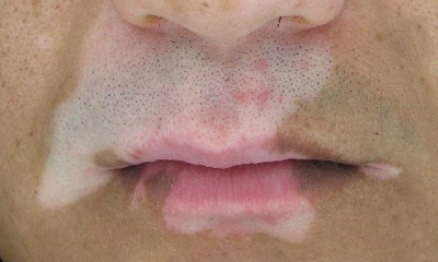 面部白癜风能用手术治疗吗