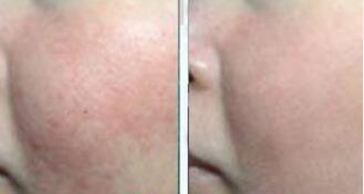 308治疗面部白癜风多久有效果