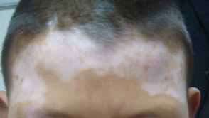 激光治疗面部白癜风多久才有效果