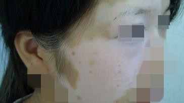 面部白癜风患者需要了解哪些治疗常识