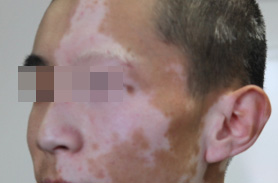 脸上出现的白癜风该用什么方法治疗