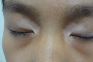 患者脸部白癜风做皮肤ct需要多少钱