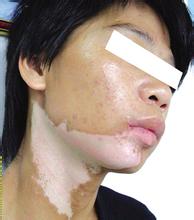 青年颈部白癜风激光治疗后发红怎么办