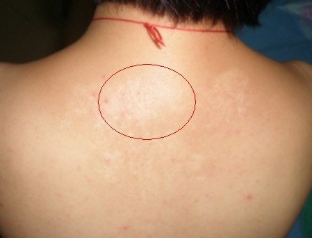 哪种药物治疗颈部白癜风疾病效果好